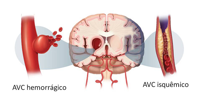 avc1