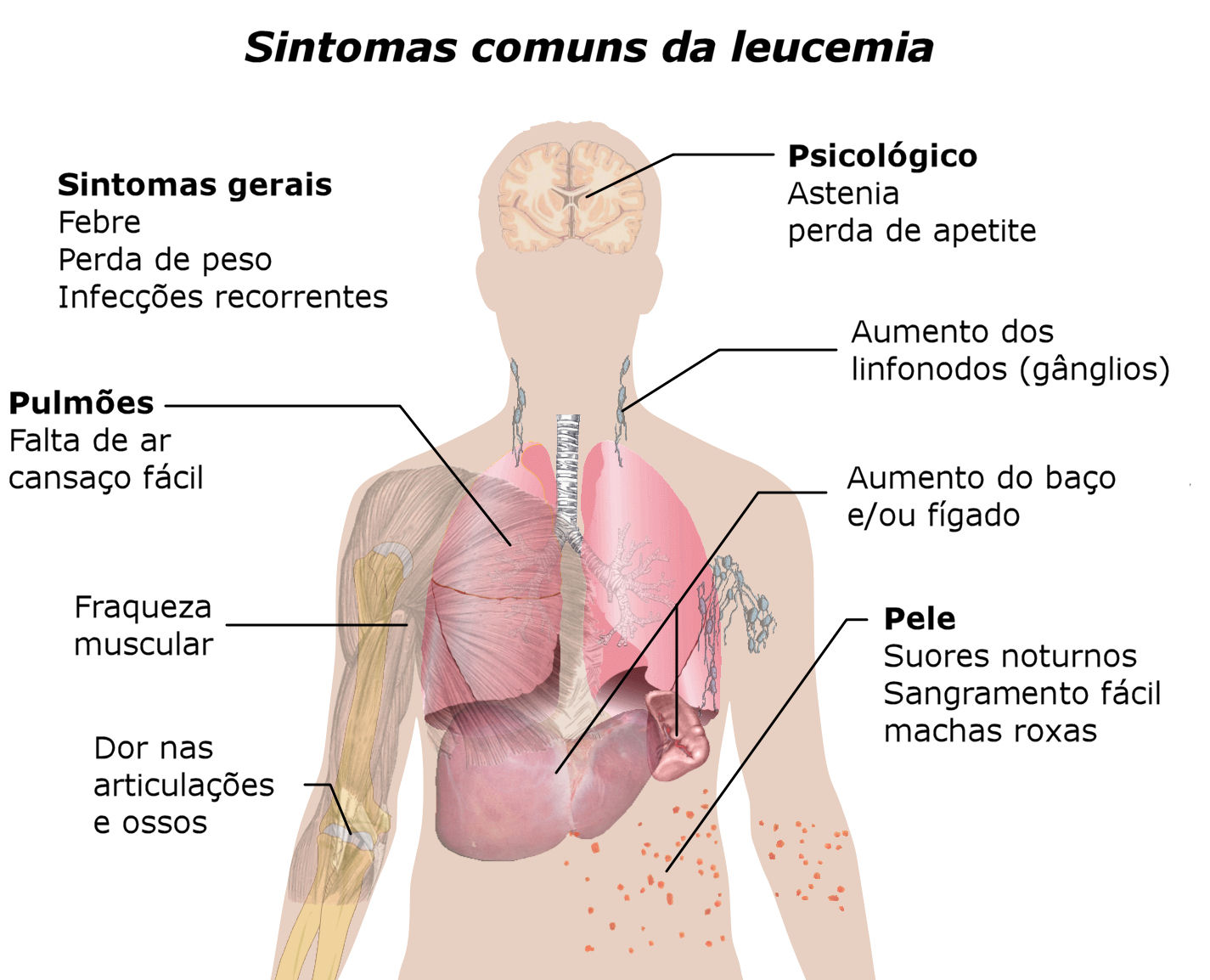 leucemia